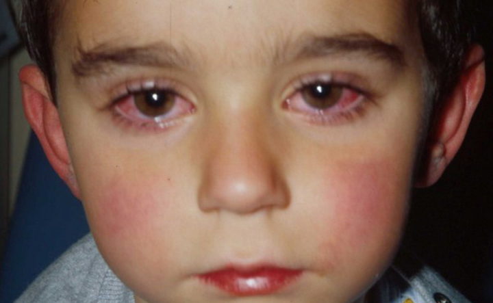 alerg chniy kon yunktiv t u d tey simptomi vidi l kuvannya narodn zasobi krapl dlya ochey ta nsh rekomendac foto 2 - Алергічний кон’юнктивіт у дітей: симптоми, види, лікування (народні засоби, краплі для очей) та інші рекомендації + фото