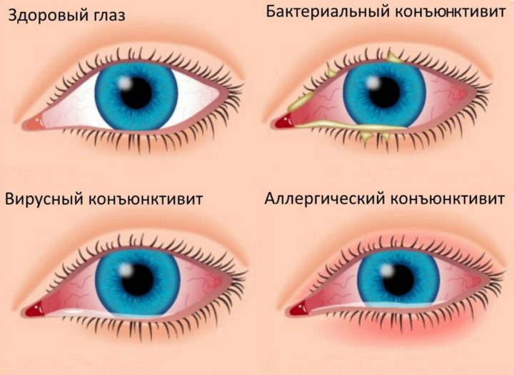 alerg chniy kon yunktiv t u d tey simptomi vidi l kuvannya narodn zasobi krapl dlya ochey ta nsh rekomendac foto 5 - Алергічний кон’юнктивіт у дітей: симптоми, види, лікування (народні засоби, краплі для очей) та інші рекомендації + фото