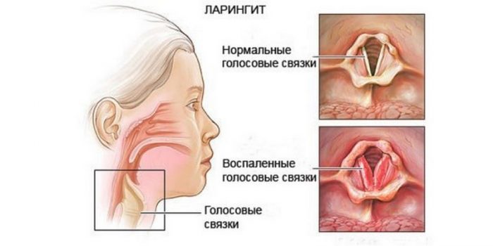 alerg ya u nemovlyati yak proyavlya t sya yak viglyada nemovlya p d chas hvorobi n zh l kuvati prof laktika 12 - Алергія у немовляти: як проявляється, як виглядає немовля під час хвороби, ніж лікувати, профілактика