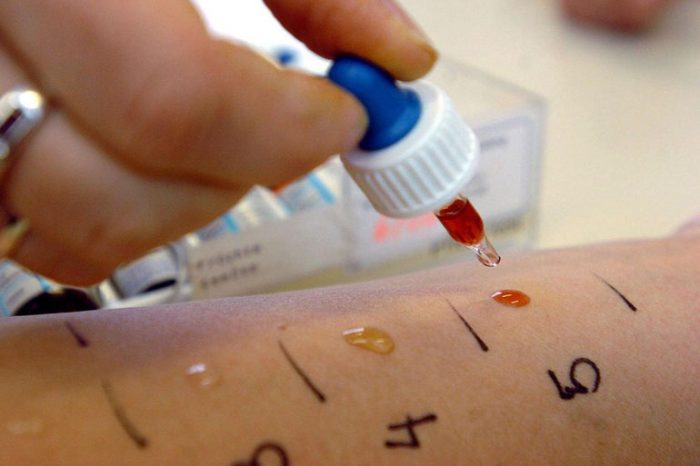 alerg ya u nemovlyati yak proyavlya t sya yak viglyada nemovlya p d chas hvorobi n zh l kuvati prof laktika 14 - Алергія у немовляти: як проявляється, як виглядає немовля під час хвороби, ніж лікувати, профілактика