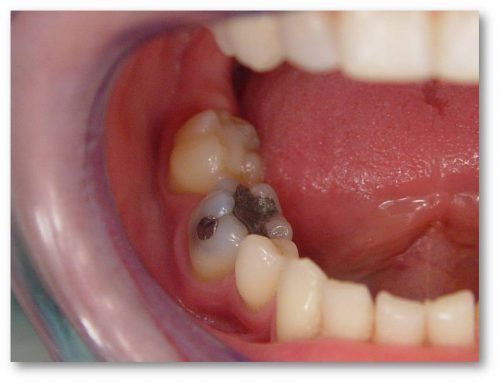 amal gama stomatolog ya plombi sklad mozhlivu shkodu perevagi 3 - Амальгама стоматологія: пломби, склад, можливу шкоду, переваги