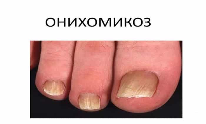 amorolak nstrukc ya z zastosuvannya c na v dguki analogi 4 - АМОРОЛАК – інструкція із застосування, ціна, відгуки і аналоги