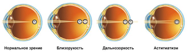 astigmatizm u d tey l kuvannya simptomi prichini vidi foto v deo 2 - Астигматизм у дітей: лікування, симптоми, причини, види, фото і відео