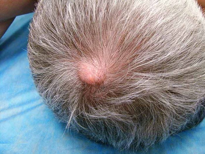 ateroma na golov simptomi l kuvannya u d tey ta doroslih prof laktika foto mozhliv uskladnennya 2 - Атерома на голові: симптоми, лікування у дітей та дорослих, профілактика, фото, можливі ускладнення