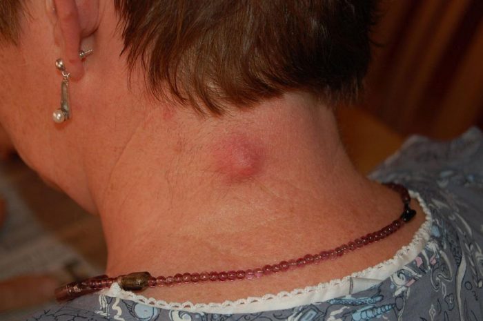 ateroma na golov simptomi l kuvannya u d tey ta doroslih prof laktika foto mozhliv uskladnennya 3 - Атерома на голові: симптоми, лікування у дітей та дорослих, профілактика, фото, можливі ускладнення