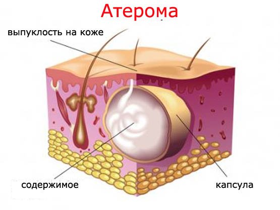 ateroma na golov simptomi l kuvannya u d tey ta doroslih prof laktika foto mozhliv uskladnennya 7 - Атерома на голові: симптоми, лікування у дітей та дорослих, профілактика, фото, можливі ускладнення