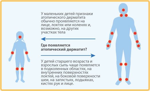 atop chniy dermatit scho ce 3 - Атопічний дерматит – що це?
