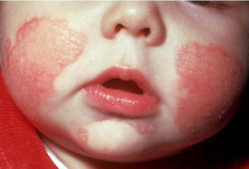 atop chniy dermatit scho ce 5 - Атопічний дерматит – що це?