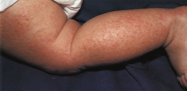 atop chniy dermatit scho ce 6 - Атопічний дерматит – що це?
