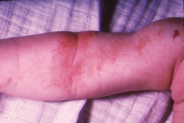 atop chniy dermatit scho ce 7 - Атопічний дерматит – що це?