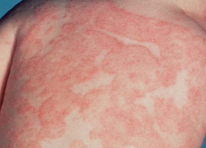 atop chniy dermatit u nemovlyat novonarodzhenogo l kuvannya d ta dlya ditini mami prichini simptomi 3 - Атопічний дерматит у немовлят і новонародженого: лікування, дієта для дитини і мами, причини і симптоми
