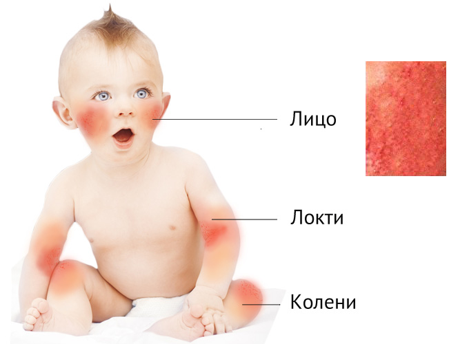 atop chniy dermatit u nemovlyat novonarodzhenogo l kuvannya d ta dlya ditini mami prichini simptomi 4 - Атопічний дерматит у немовлят і новонародженого: лікування, дієта для дитини і мами, причини і симптоми