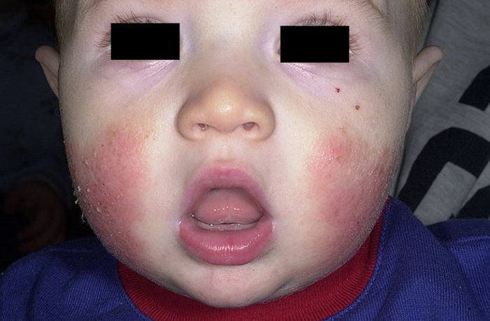 atop chniy dermatit u nemovlyat novonarodzhenogo l kuvannya d ta dlya ditini mami prichini simptomi 6 - Атопічний дерматит у немовлят і новонародженого: лікування, дієта для дитини і мами, причини і симптоми