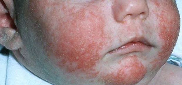 atop chniy dermatit u nemovlyat novonarodzhenogo l kuvannya d ta dlya ditini mami prichini simptomi 8 - Атопічний дерматит у немовлят і новонародженого: лікування, дієта для дитини і мами, причини і симптоми