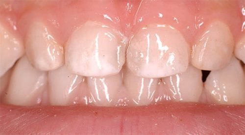 b l plyami na zubah u ditini l kuvannya prof laktika g poplaz 3 - Білі плями на зубах у дитини: лікування, профілактика гіпоплазії