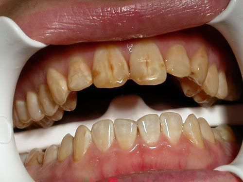b l plyami na zubah u ditini l kuvannya prof laktika g poplaz 4 - Білі плями на зубах у дитини: лікування, профілактика гіпоплазії