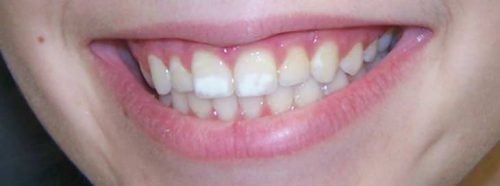 b l plyami na zubah u doroslih chomu z yavlyayut sya prichini 1 - Білі плями на зубах у дорослих: чому з’являються, причини