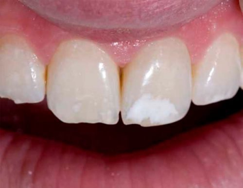 b l plyami na zubah u doroslih chomu z yavlyayut sya prichini 5 - Білі плями на зубах у дорослих: чому з’являються, причини