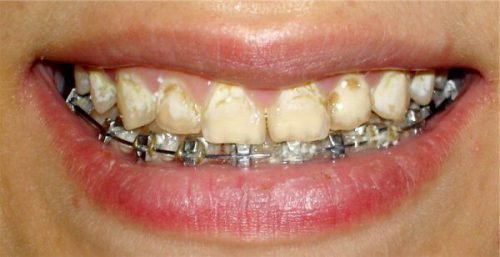 b l plyami na zubah u doroslih chomu z yavlyayut sya prichini 8 - Білі плями на зубах у дорослих: чому з’являються, причини