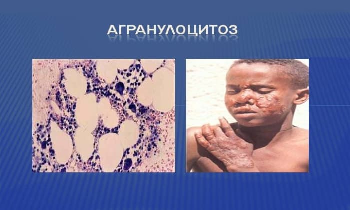 b septol 480 nstrukc ya z zastosuvannya c na v dguki analogi 33 - БІСЕПТОЛ 480 – Інструкція із застосування, ціна, відгуки і аналоги