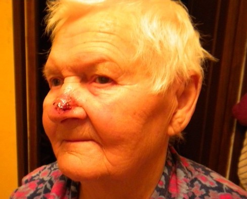 bazal oma shk ri nosa vidi prichini viniknennya simptomi d agnostika l kuvannya oprom nennya narodn zasobi toscho prognoz oduzhannya foto 14 - Базаліома шкіри носа: види, причини виникнення, симптоми, діагностика, лікування (опромінення, народні засоби тощо) і прогноз одужання + фото