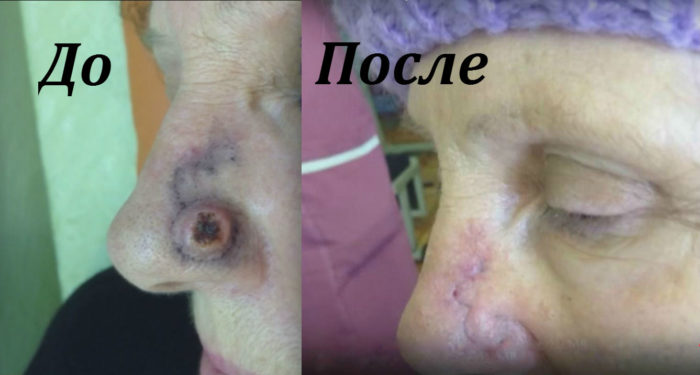 bazal oma shk ri nosa vidi prichini viniknennya simptomi d agnostika l kuvannya oprom nennya narodn zasobi toscho prognoz oduzhannya foto 20 - Базаліома шкіри носа: види, причини виникнення, симптоми, діагностика, лікування (опромінення, народні засоби тощо) і прогноз одужання + фото
