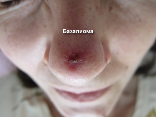 bazal oma shk ri nosa vidi prichini viniknennya simptomi d agnostika l kuvannya oprom nennya narodn zasobi toscho prognoz oduzhannya foto 4 - Базаліома шкіри носа: види, причини виникнення, симптоми, діагностика, лікування (опромінення, народні засоби тощо) і прогноз одужання + фото