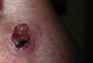 bazal oma shk ri nosa vidi prichini viniknennya simptomi d agnostika l kuvannya oprom nennya narodn zasobi toscho prognoz oduzhannya foto 8 - Базаліома шкіри носа: види, причини виникнення, симптоми, діагностика, лікування (опромінення, народні засоби тощо) і прогноз одужання + фото