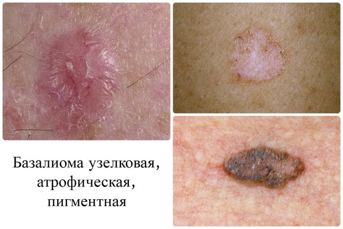 bazal oma shk ri oblichchya vidi prichini simptomi l kuvannya v tomu chisl narodnimi zasobami prognoz oduzhannya foto 3 - Базаліома шкіри обличчя: види, причини, симптоми, лікування (в тому числі народними засобами) і прогноз одужання + фото