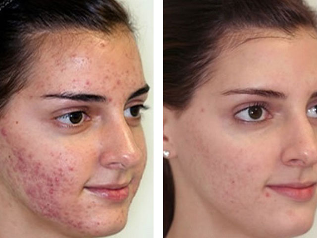 baziron v d prisch v v dguki yak koristuvatisya protipokazannya pob chn d ta nsh rekomendac dermatolog v 3 - Базирон від прищів: відгуки, як користуватися, протипоказання, побічні дії та інші рекомендації дерматологів
