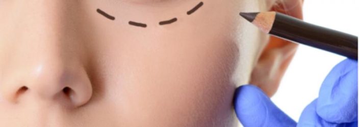 blefaroplastika verhn h nizhn h pov k dlya omolodzhennya protipokazannya efekt uskladnennya reab l tac ya ta nsh aspekti foto v dguki 1 - Блефаропластика (верхніх і нижніх повік) для омолодження: протипоказання, ефект, ускладнення, реабілітація та інші аспекти + фото і відгуки