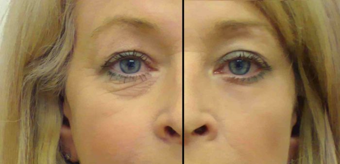 blefaroplastika verhn h nizhn h pov k dlya omolodzhennya protipokazannya efekt uskladnennya reab l tac ya ta nsh aspekti foto v dguki 2 - Блефаропластика (верхніх і нижніх повік) для омолодження: протипоказання, ефект, ускладнення, реабілітація та інші аспекти + фото і відгуки