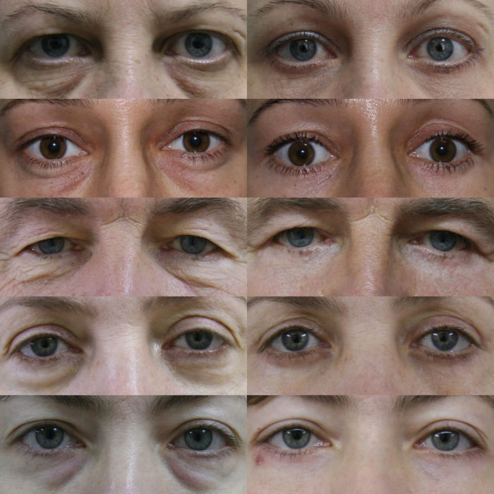 blefaroplastika verhn h nizhn h pov k dlya omolodzhennya protipokazannya efekt uskladnennya reab l tac ya ta nsh aspekti foto v dguki 3 - Блефаропластика (верхніх і нижніх повік) для омолодження: протипоказання, ефект, ускладнення, реабілітація та інші аспекти + фото і відгуки