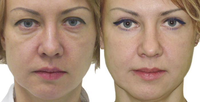 blefaroplastika verhn h nizhn h pov k dlya omolodzhennya protipokazannya efekt uskladnennya reab l tac ya ta nsh aspekti foto v dguki 4 - Блефаропластика (верхніх і нижніх повік) для омолодження: протипоказання, ефект, ускладнення, реабілітація та інші аспекти + фото і відгуки