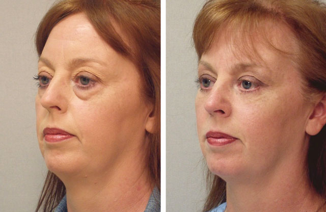 blefaroplastika verhn h nizhn h pov k dlya omolodzhennya protipokazannya efekt uskladnennya reab l tac ya ta nsh aspekti foto v dguki 5 - Блефаропластика (верхніх і нижніх повік) для омолодження: протипоказання, ефект, ускладнення, реабілітація та інші аспекти + фото і відгуки