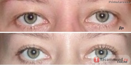 blefaroplastika verhn h nizhn h pov k dlya omolodzhennya protipokazannya efekt uskladnennya reab l tac ya ta nsh aspekti foto v dguki 6 - Блефаропластика (верхніх і нижніх повік) для омолодження: протипоказання, ефект, ускладнення, реабілітація та інші аспекти + фото і відгуки