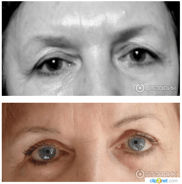 blefaroplastika verhn h nizhn h pov k dlya omolodzhennya protipokazannya efekt uskladnennya reab l tac ya ta nsh aspekti foto v dguki 7 - Блефаропластика (верхніх і нижніх повік) для омолодження: протипоказання, ефект, ускладнення, реабілітація та інші аспекти + фото і відгуки