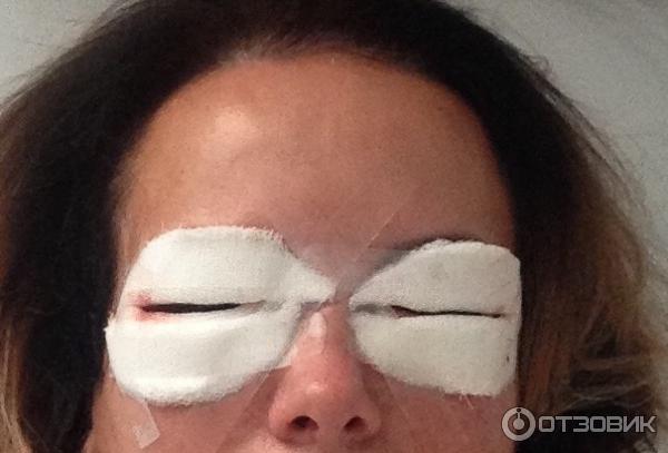 blefaroplastika verhn h nizhn h pov k dlya omolodzhennya protipokazannya efekt uskladnennya reab l tac ya ta nsh aspekti foto v dguki 8 - Блефаропластика (верхніх і нижніх повік) для омолодження: протипоказання, ефект, ускладнення, реабілітація та інші аспекти + фото і відгуки