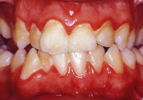 bolit desna b lya zuba scho robiti v domashn h umovah 3 - Болить десна біля зуба: що робити в домашніх умовах