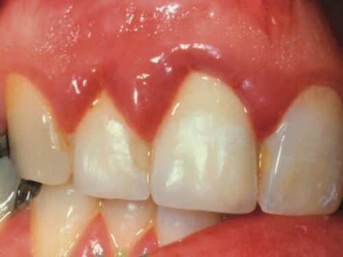 bolit desna m zh zubami prichini sposobi l kuvannya 2 - Болить десна між зубами: причини, способи лікування