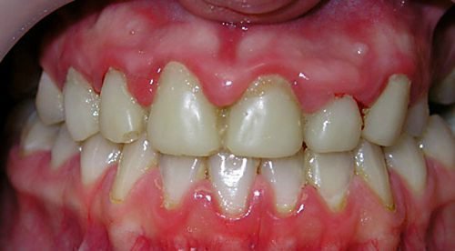 bolit desna v k nc verhn o schelepi nad zubami prichini scho robiti 1 - Болить десна в кінці верхньої щелепи над зубами: причини, що робити