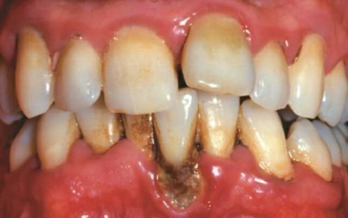 bolit desna v k nc verhn o schelepi nad zubami prichini scho robiti 3 - Болить десна в кінці верхньої щелепи над зубами: причини, що робити