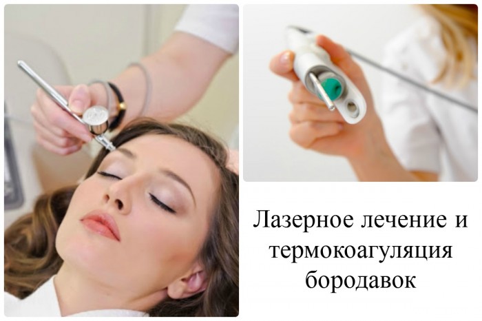 borodavki na oblichch prichini poyavi tradic yne l kuvannya narodn zasobi foto v deo 4 - Бородавки на обличчі: причини появи, традиційне лікування і народні засоби, фото і відео