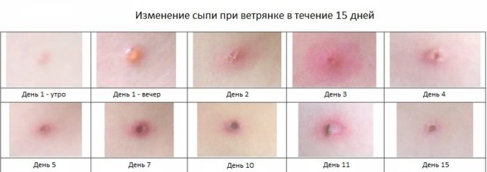 chi mozhna zarazitisya zahvor ti v tryankoyu drugiy raz doroslomu ditin simptomi ta osoblivost povtornogo zahvoryuvannya 3 - чи Можна заразитися і захворіти вітрянкою другий раз дорослому і дитині: симптоми та особливості повторного захворювання