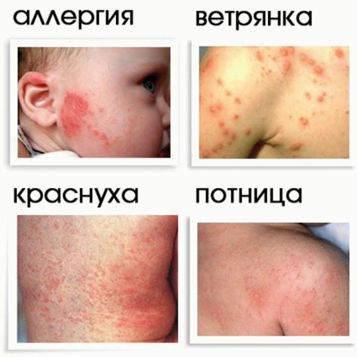 chi mozhna zarazitisya zahvor ti v tryankoyu drugiy raz doroslomu ditin simptomi ta osoblivost povtornogo zahvoryuvannya 5 - чи Можна заразитися і захворіти вітрянкою другий раз дорослому і дитині: симптоми та особливості повторного захворювання