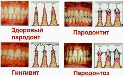 chomu bolit desna b lya zuba prichini niyuchogo bolyu 2 - Чому болить десна біля зуба: причини ниючого болю