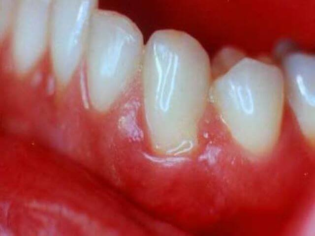chomu bolit desna b lya zuba prichini niyuchogo bolyu 4 - Чому болить десна біля зуба: причини ниючого болю