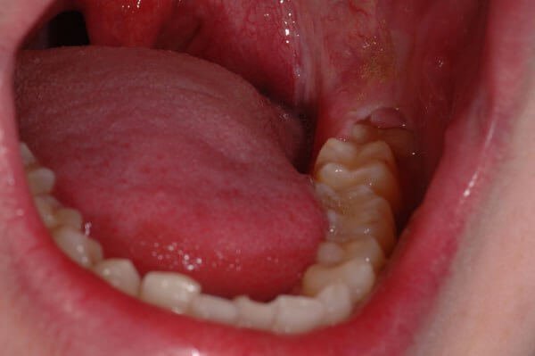 chomu bolit desna de nema zuba prichini yak l kuvati 4 - Чому болить десна де немає зуба: причини, як лікувати
