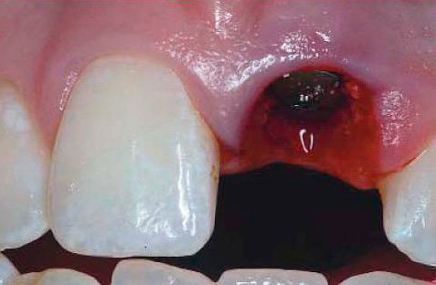 chomu bolit ni desna p slya vidalennya zuba b l she tizhnya 1 - Чому болить(ниє) десна після видалення зуба більше тижня