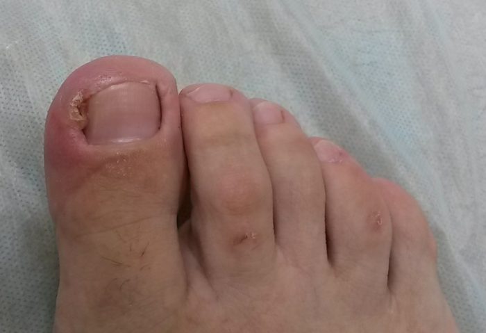 chomu n gt na rukah hvilyast prichini ner vn y poverhn n gt ovo plastini yak vir vnyati prof laktiki deformac 9 - Чому нігті на руках хвилясті: причини нерівній поверхні нігтьової пластини, як її вирівняти, профілактики деформації